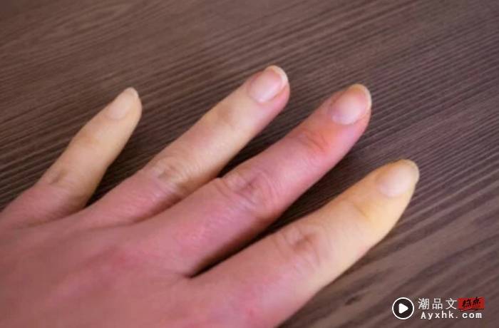 健康I 英王查尔斯手指肿得像香肠，有同款手指的人别不当回事！ 更多热点 图2张